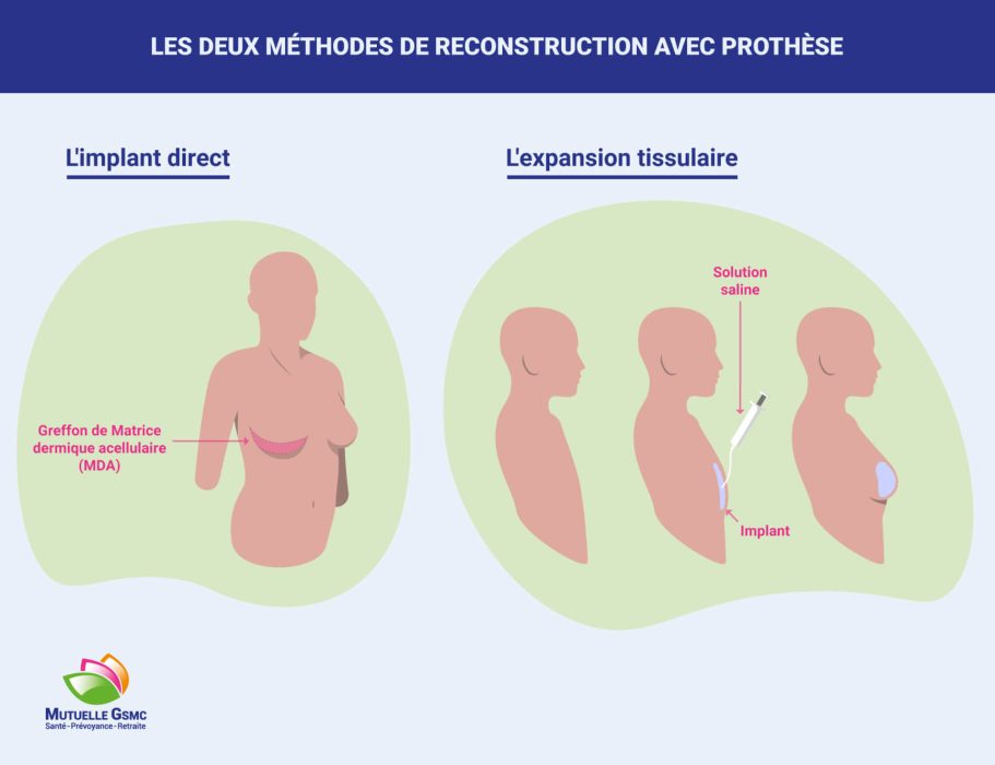 reconstruction mammaire prothèse