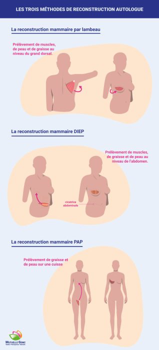 reconstruction mammaire par lambeau